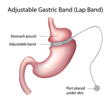Gastric Band Hypnotherapy Durham